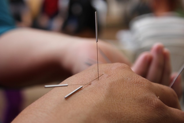 acupuncture-for-pain-relief-640x480-52009939.jpeg